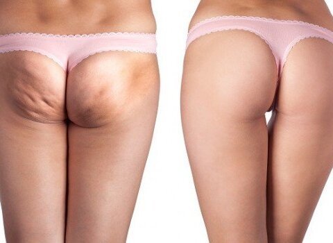 Cellulite avant apres