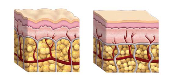 photo_cellulite