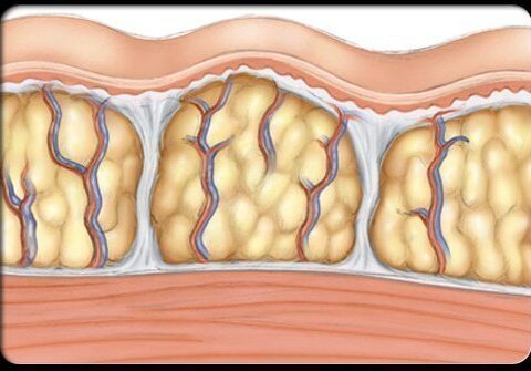 cellulite 2