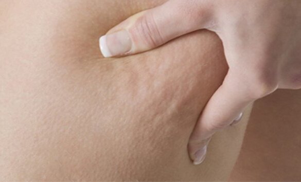 Cellulite adipeuse