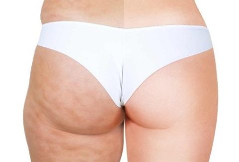 Cellulite