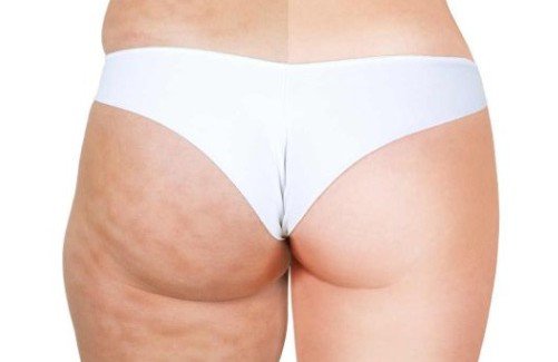 cellulite