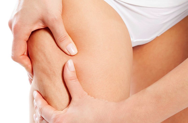 Types de cellulite