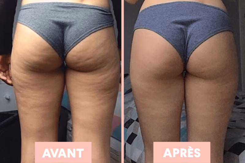 Ventouse cellulite avant après cellublue