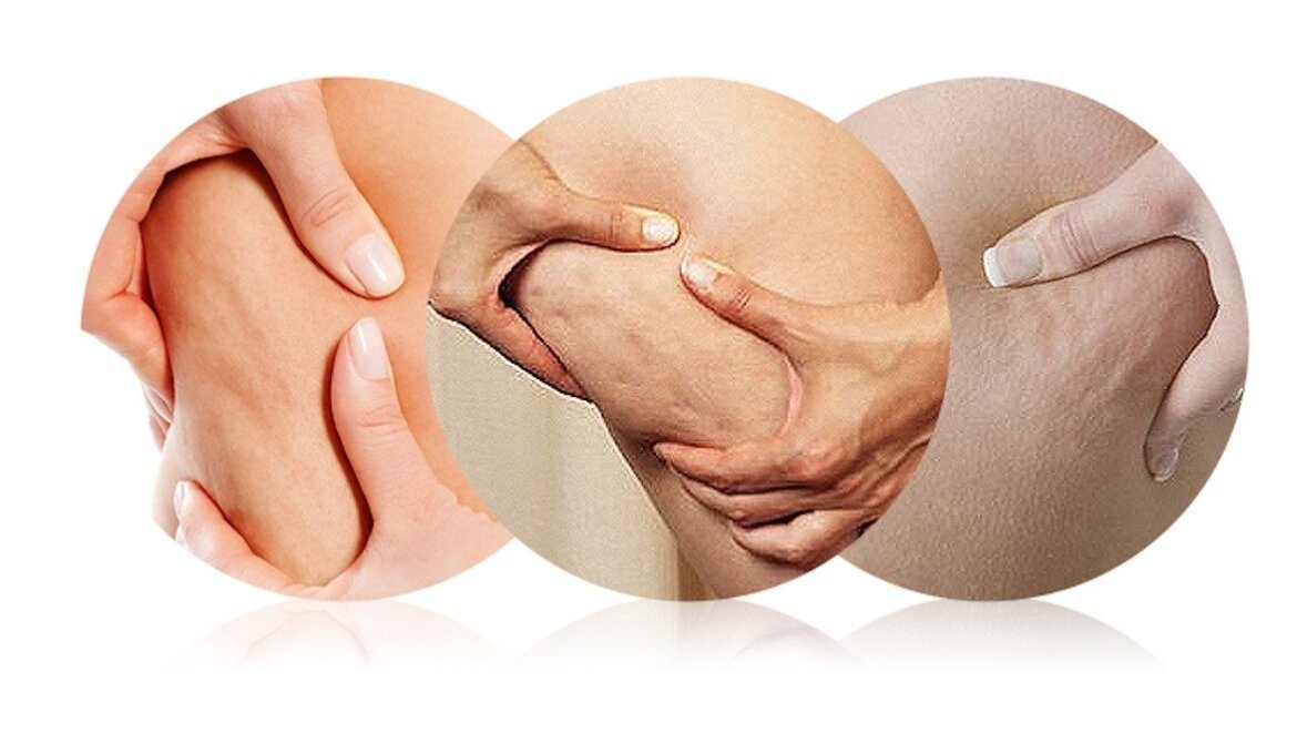 vaincre la cellulite
