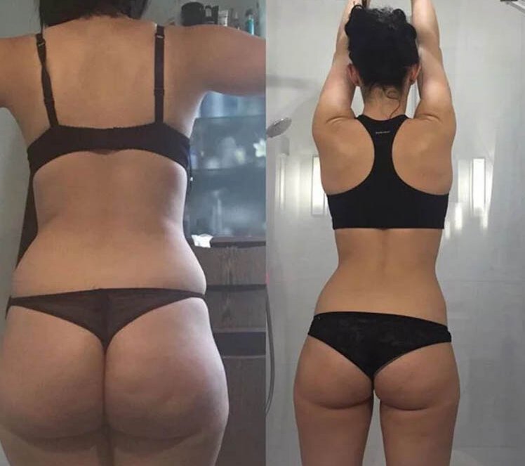 resultat ventouse anti cellulite cellublue
