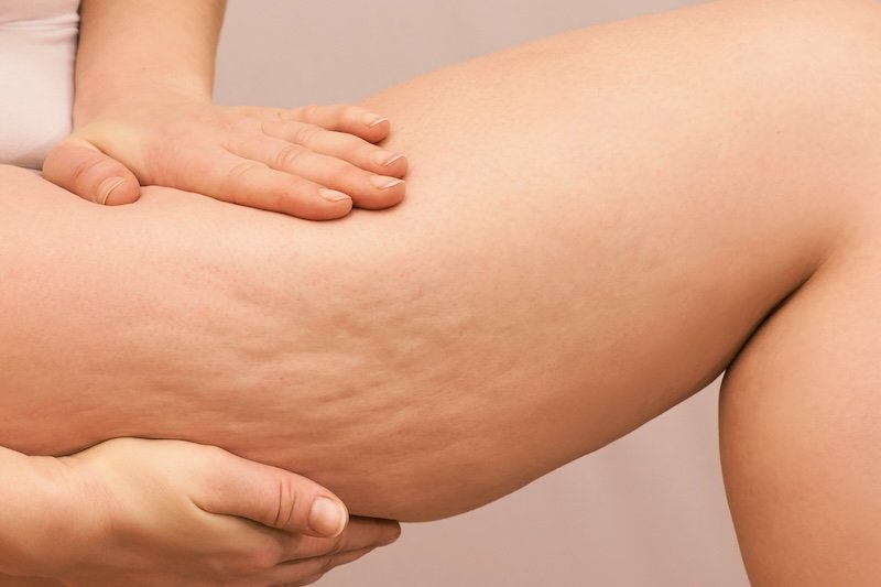 Lutter contre la cellulite