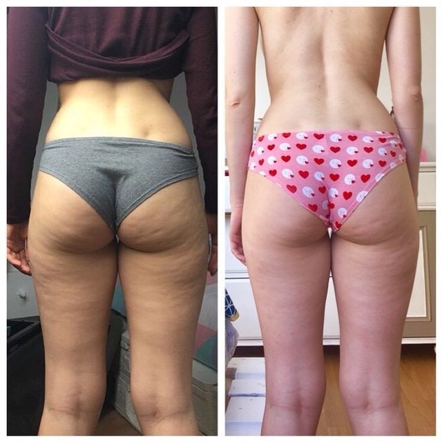 Omerine Des Fesses De Reve En Seulement 4 Semaines Cellublue