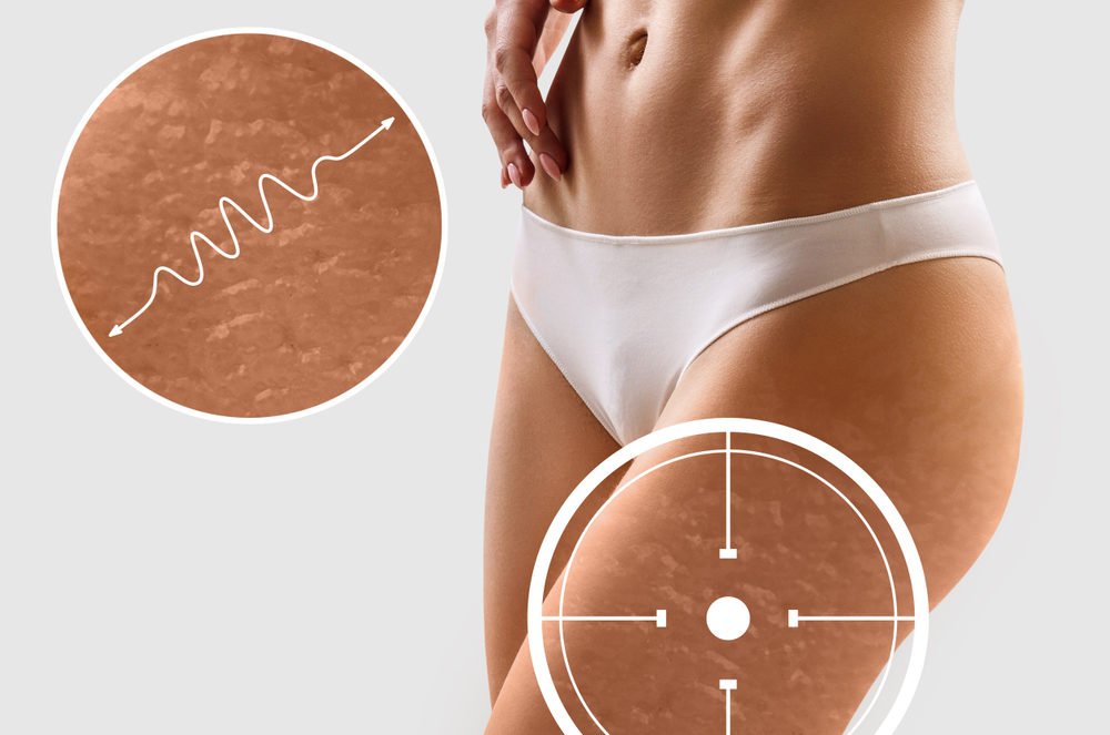 types de cellulite