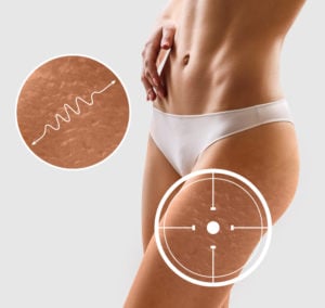 types de cellulite