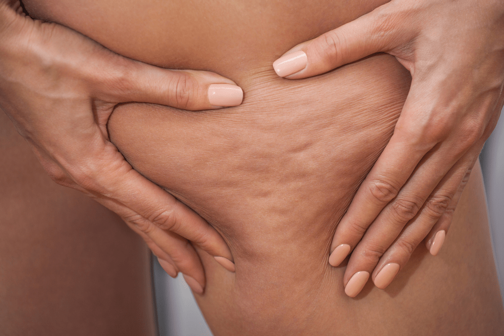 la cellulite