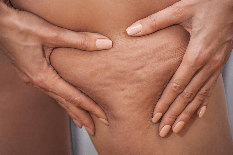 cellulite fibreuse cuisses