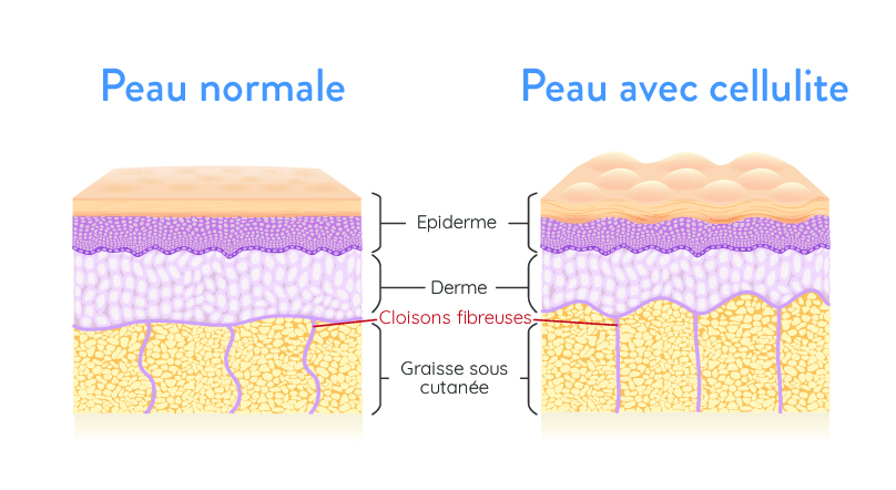 schéma cellulite