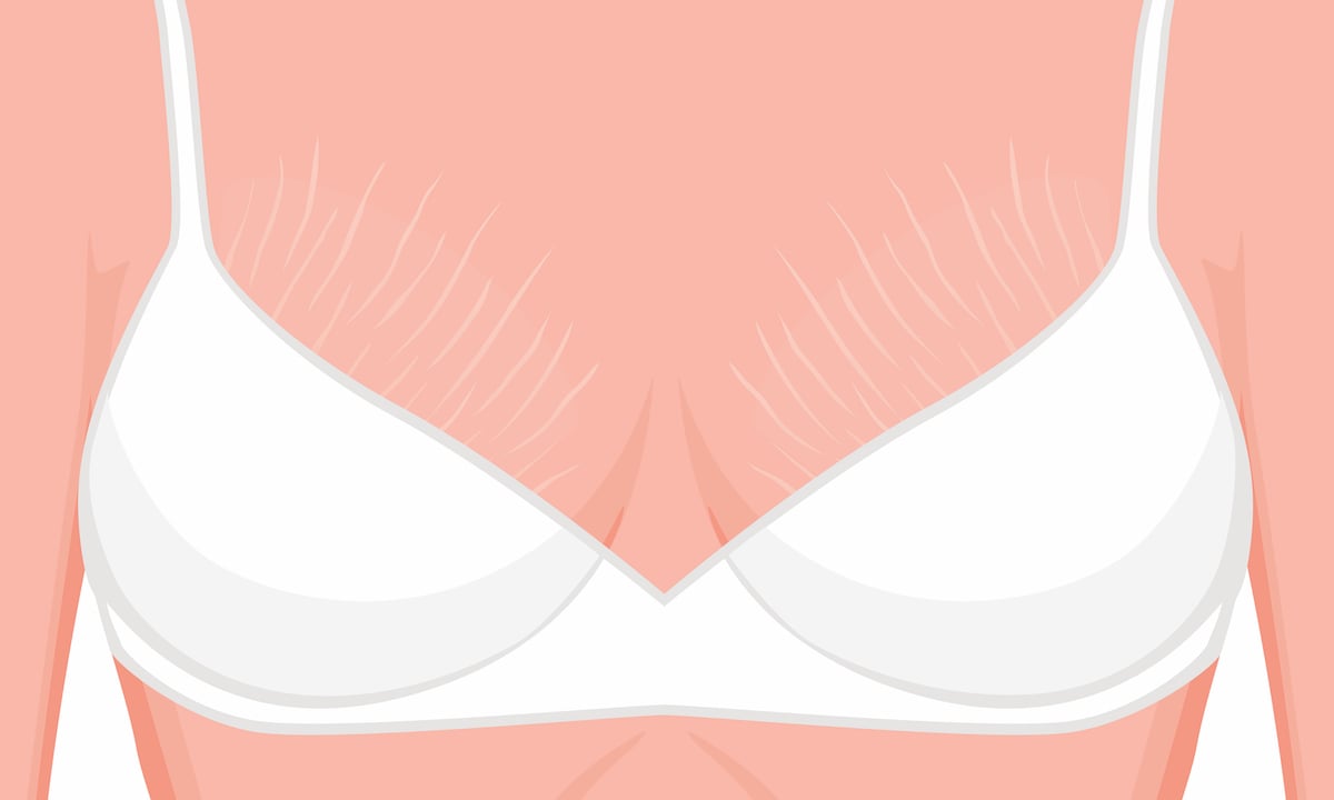 Les causes des vergetures sur les seins