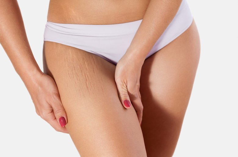 Peeling contre les vergetures