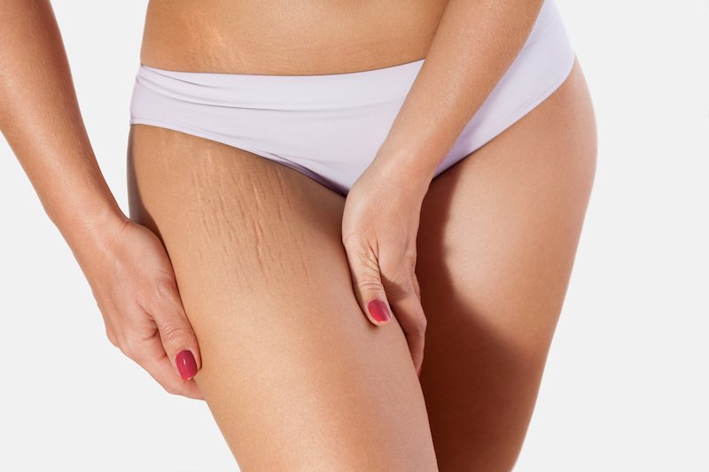 Peeling contre les vergetures