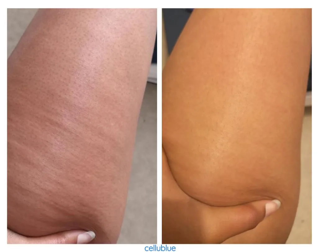 Cellulite Avant/Après : 11 témoignages produits Cellublue - Avant après avec lhuile et la ventouse cellublue
