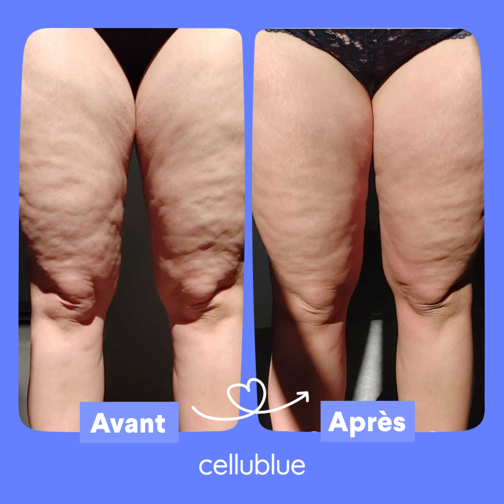 Dégainer la cellulite avec CelluBlue !