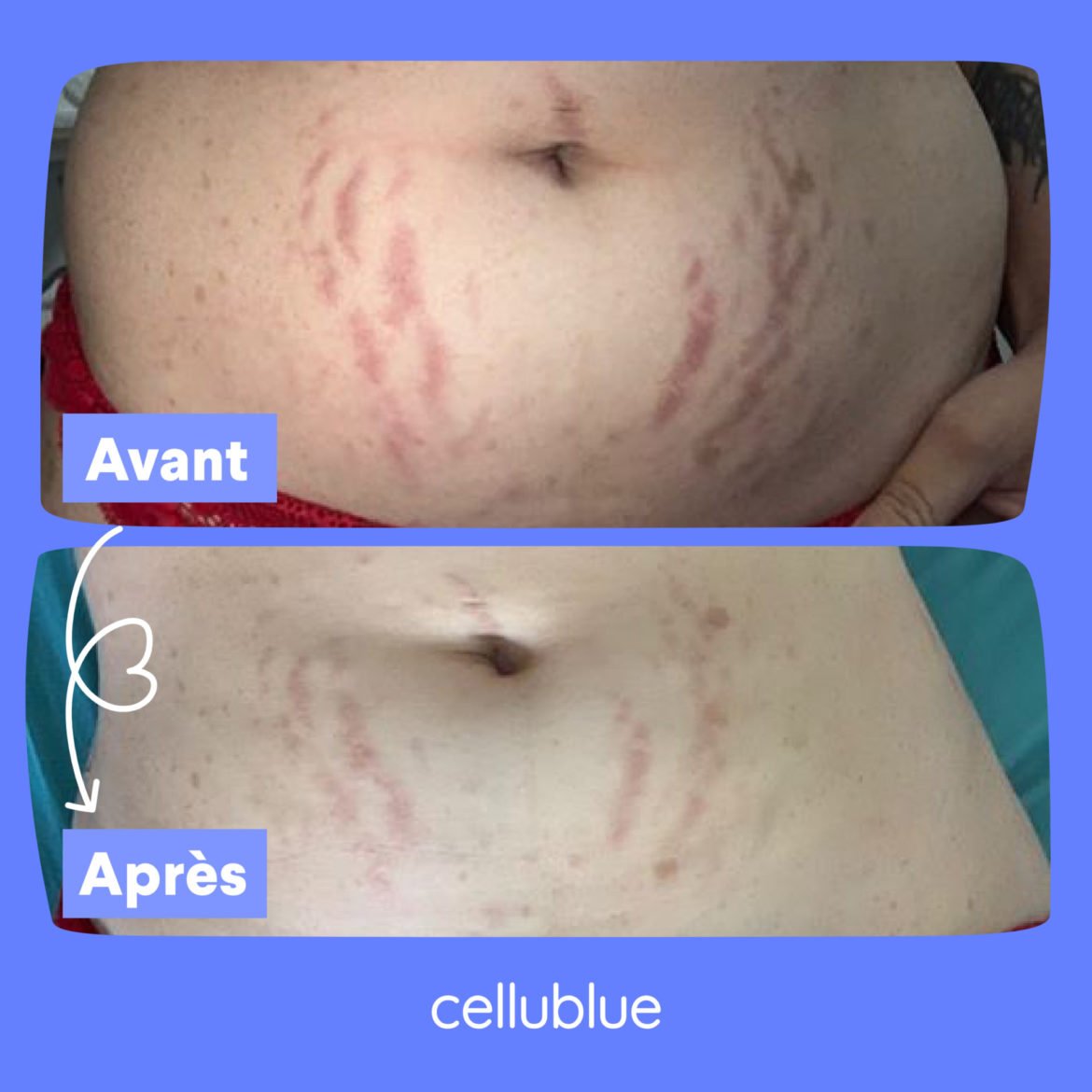 Avant apres produits vergetures cellublue