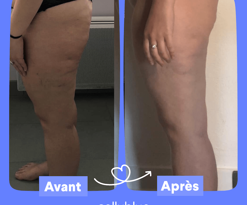 Cellulite Avant/Après : 11 témoignages produits Cellublue - Avant apres ventouse cellulite cellublue