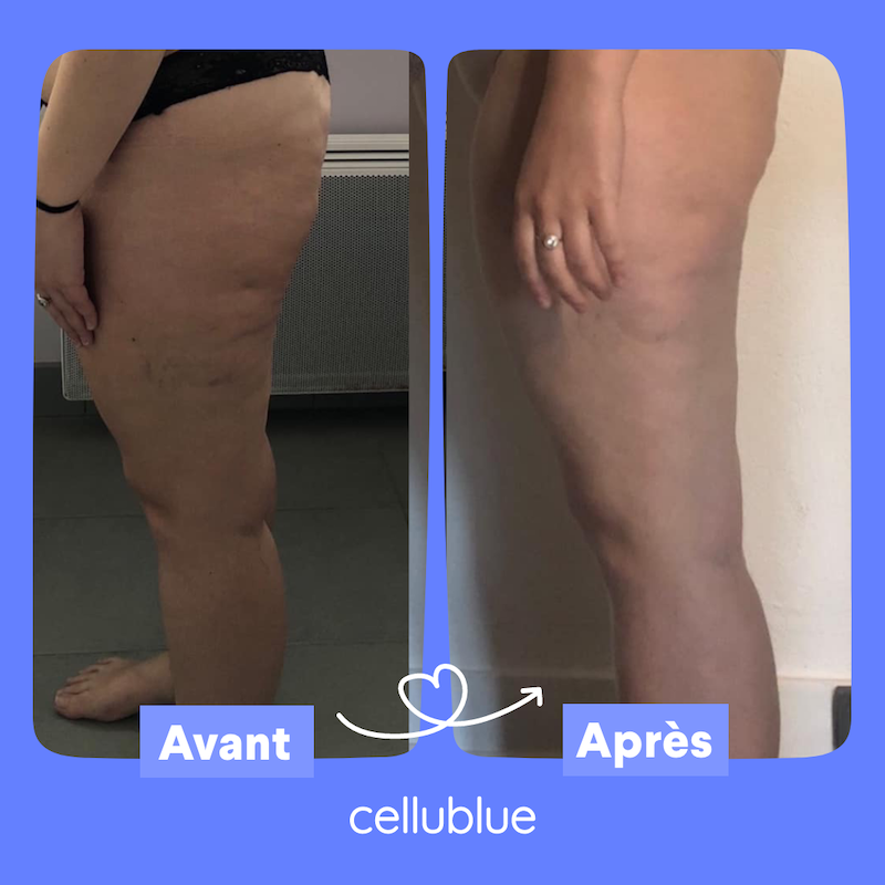 Quel effet des bas de contention sur la cellulite ? - Cellublue