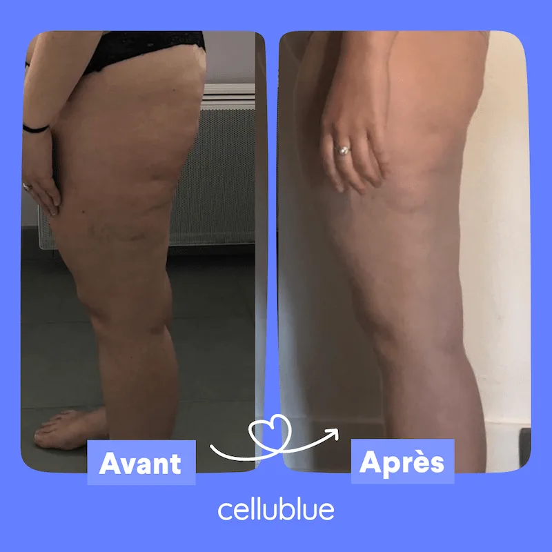 Cellulite Avant/Après : 11 témoignages produits Cellublue - Avant apres ventouse cellulite cellublue