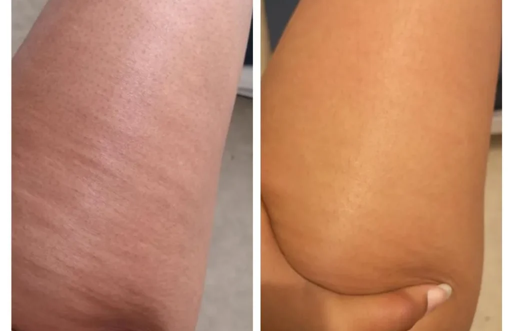 Cellulite Avant/Après : 11 témoignages produits Cellublue - Avant après avec lhuile et la ventouse cellublue