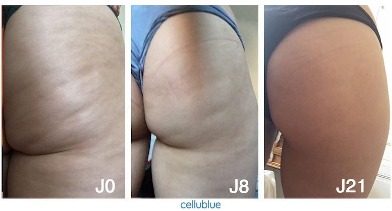 Cellulite Avant/Après : 11 témoignages produits Cellublue - Avant après de la ventouse cellublue