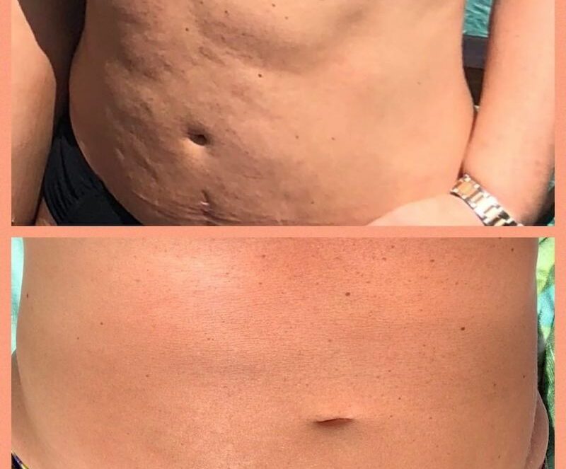 Cellulite Avant/Après : 11 témoignages produits Cellublue - Avant après de la ventouse sur le ventre cellublue
