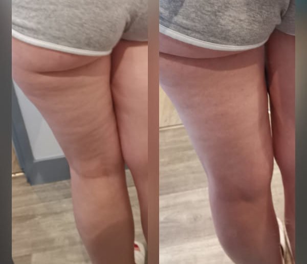 Avant après utilisation de la ventouse ems cellublue