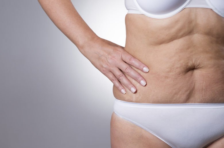 Cellulite et ménopause