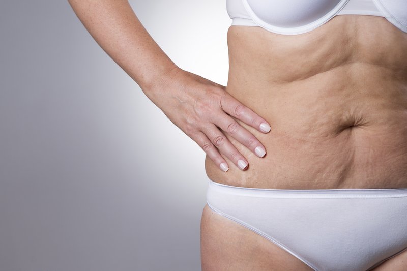 Cellulite et ménopause