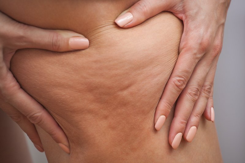 astuces enlever trous de cellulite