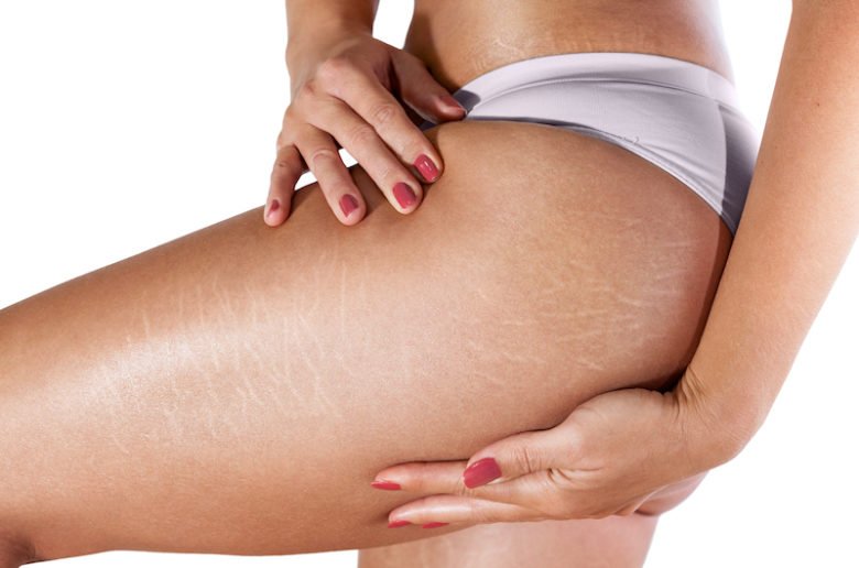 Pourquoi a t on des vergetures sur les cuisses ?