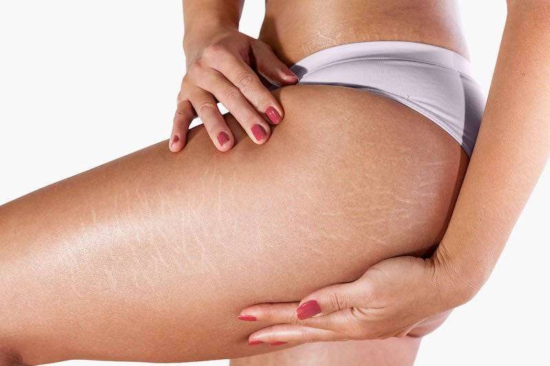 Rozstępy na udach - rozwiązania