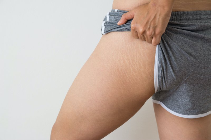 vergetures adolescence