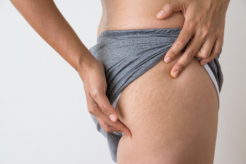 Vergetures qui grattent