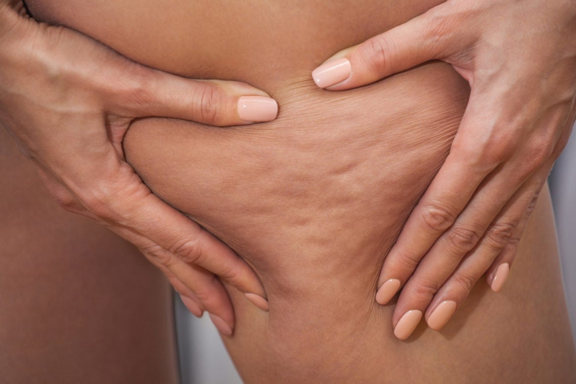 cellulite causes, traitement, solutions