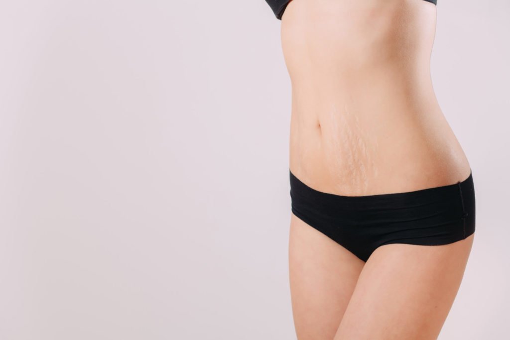 Stretch marks: causes, treatments and solutions