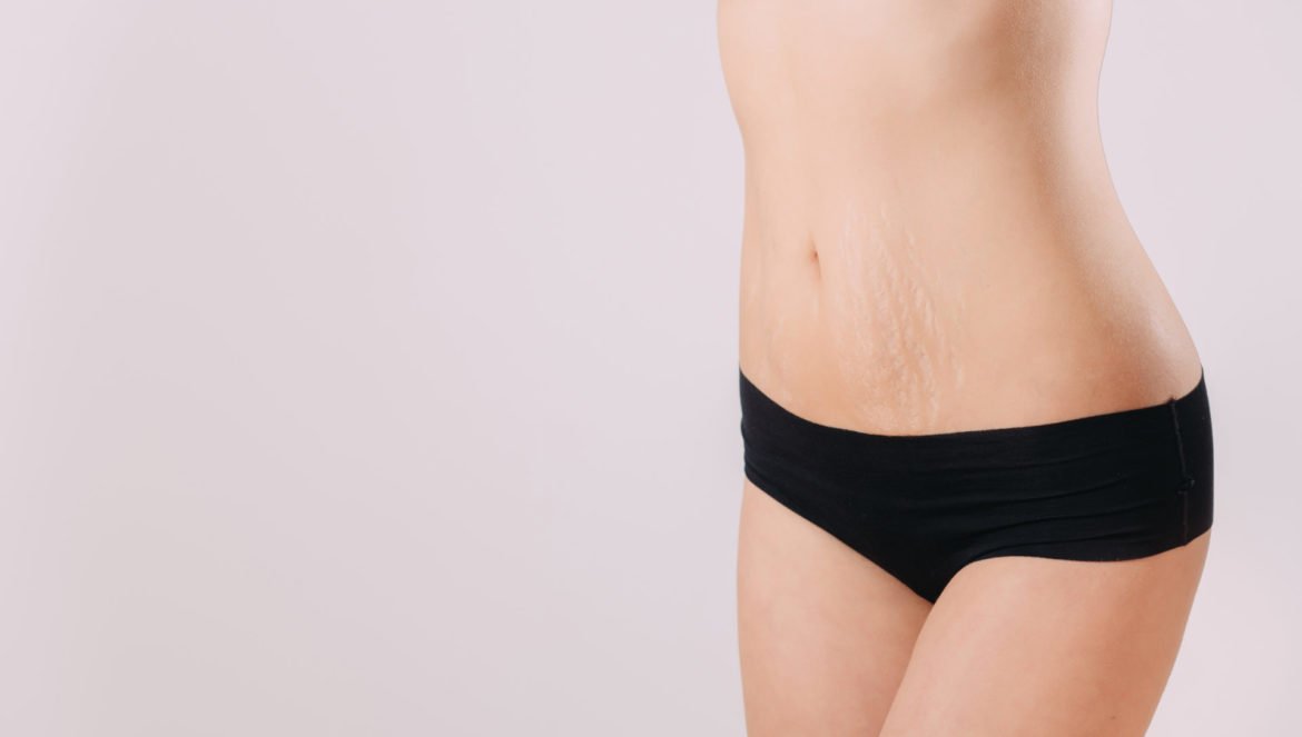 Vergetures causes traitements solutions