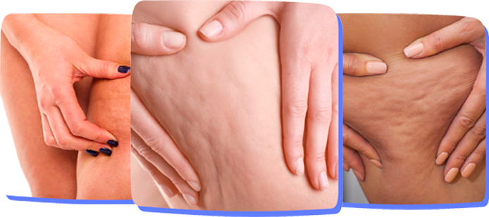 Which anti-cellulite device should you choose?