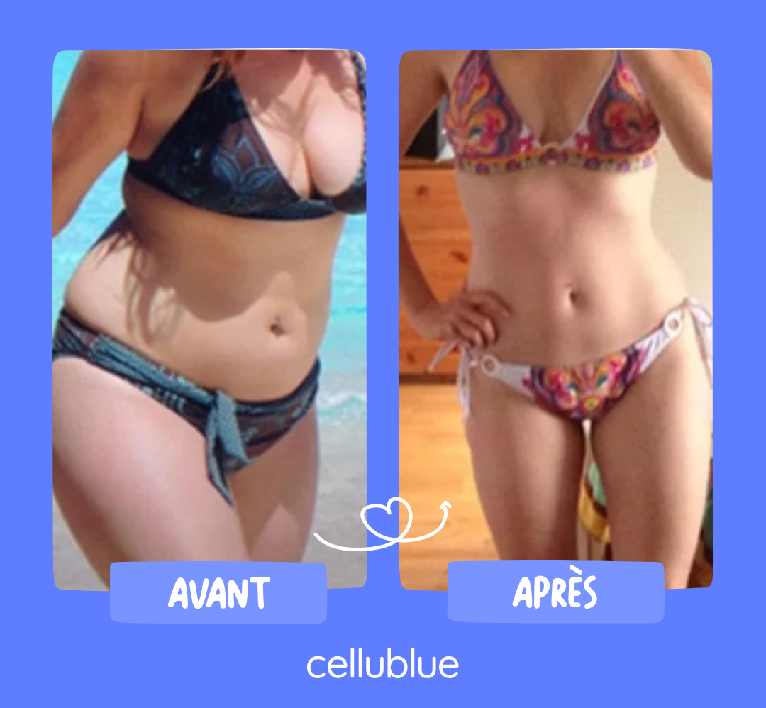 resultat ventouse anti cellulite cellublue 