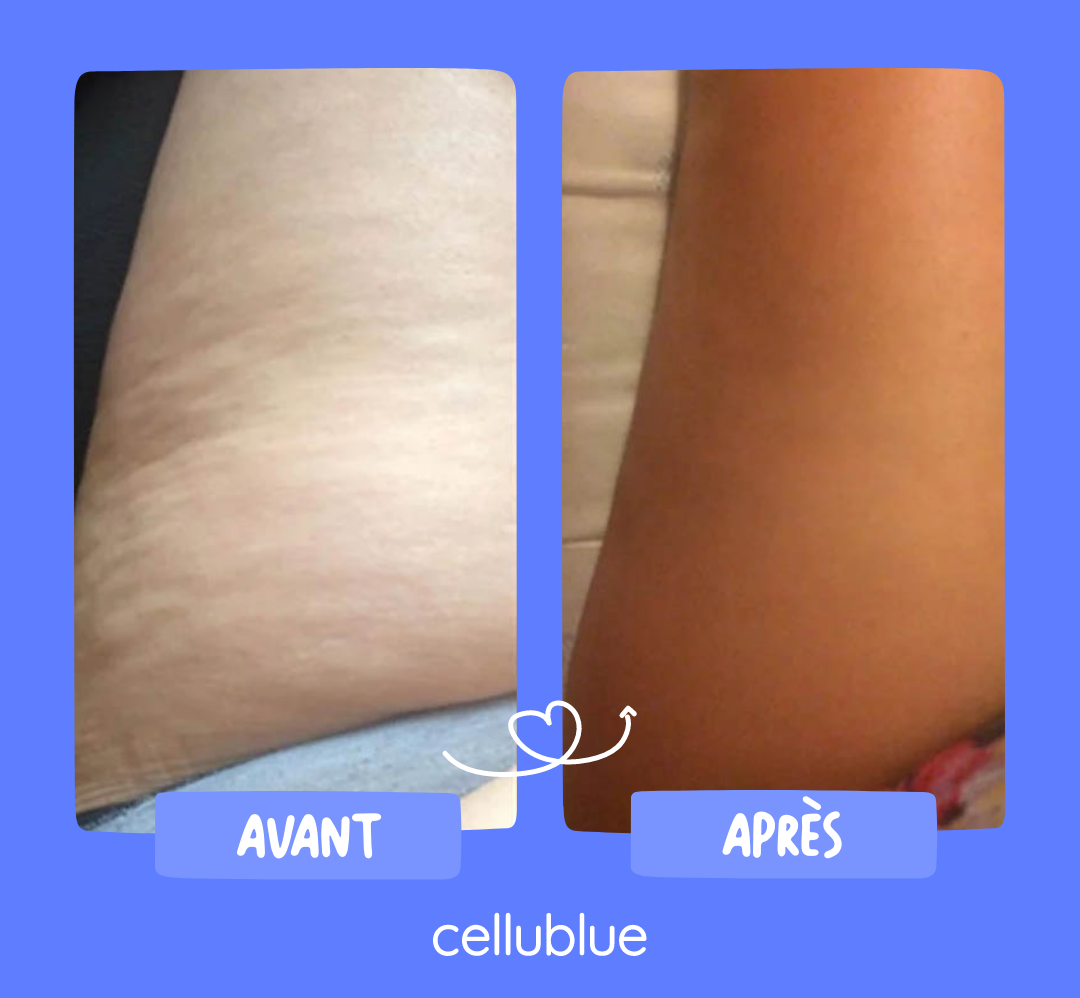 resultat ventouse anti cellulite cellublue 