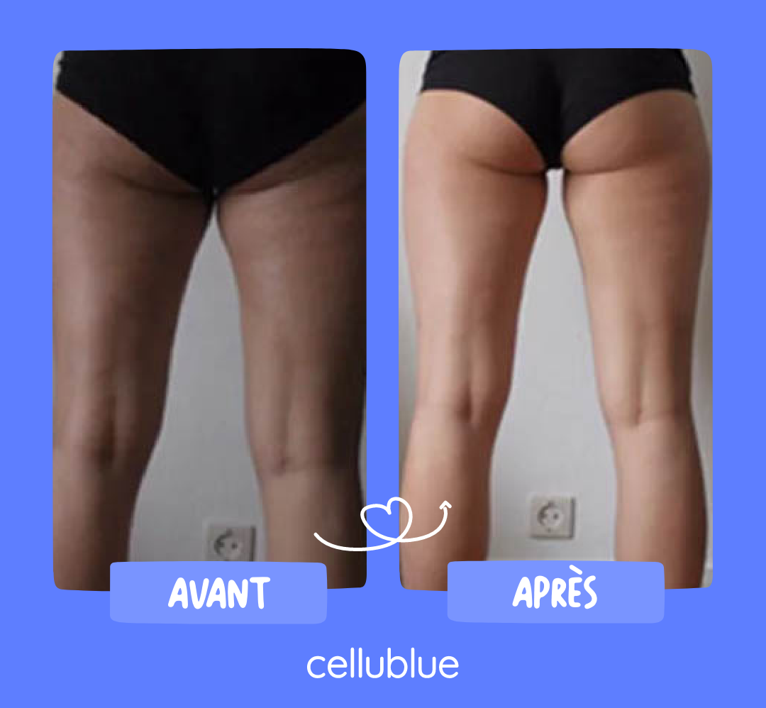 resultat ventouse anti cellulite cellublue 