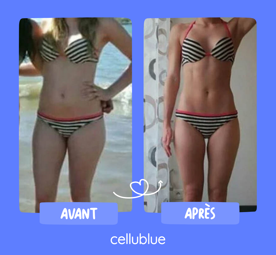 resultat ventouse anti cellulite cellublue 