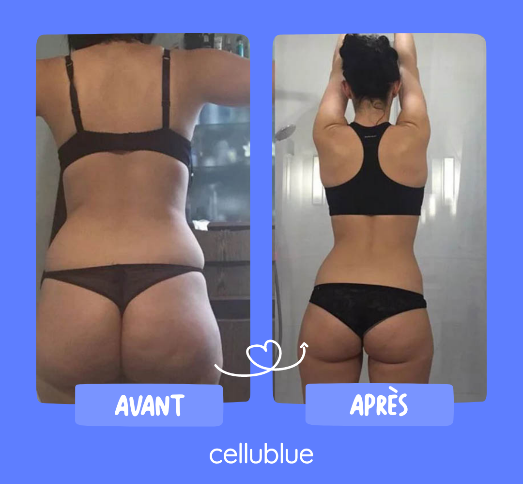 resultat ventouse anti cellulite cellublue