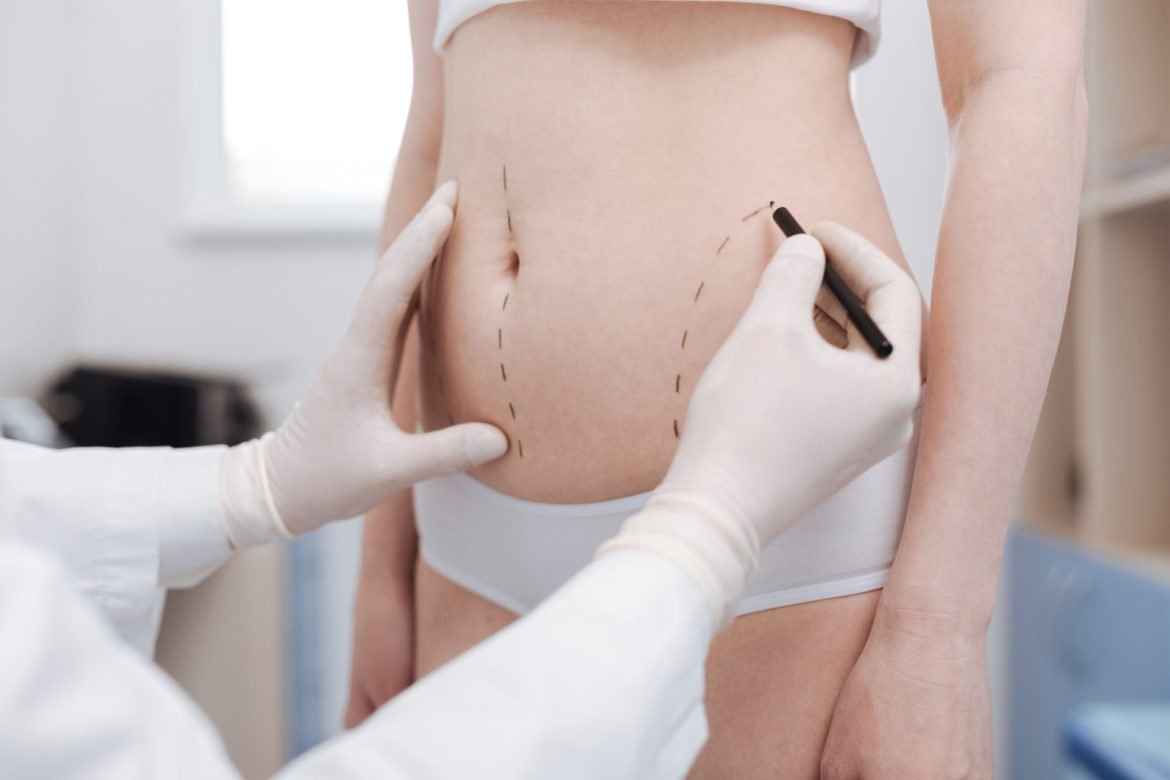 Retendre peau ventre chirurgie