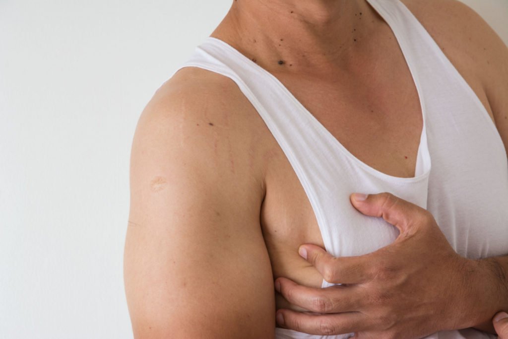 Estrias nos homens: como tratá-las?