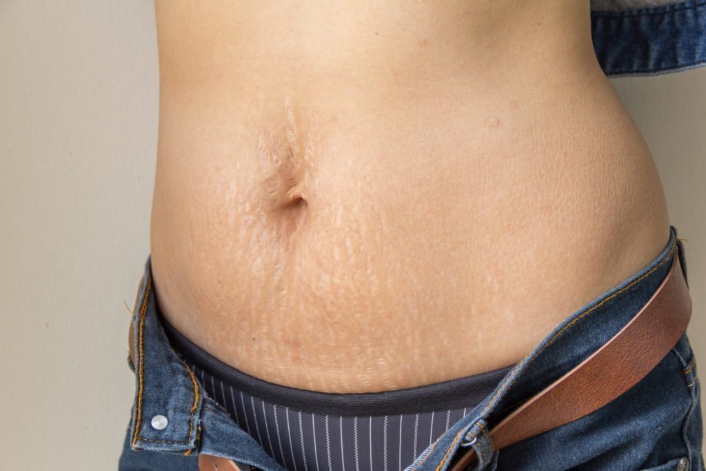 Estrías en el abdomen: causas y cómo tratarlas