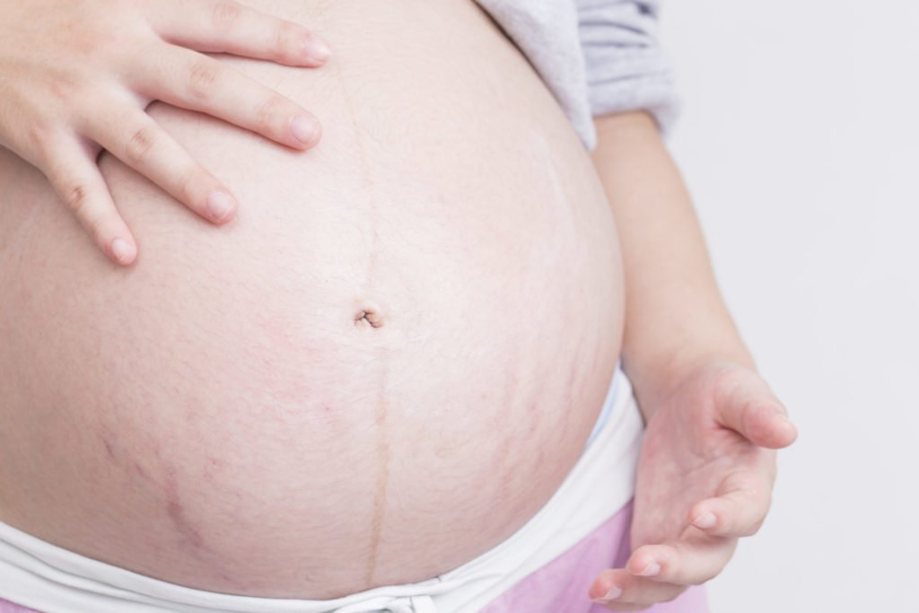 Vergetures violettes : les causes et les solutions